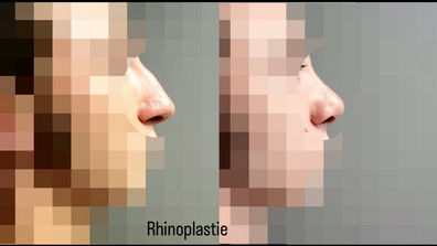 RHINOPLASTIE